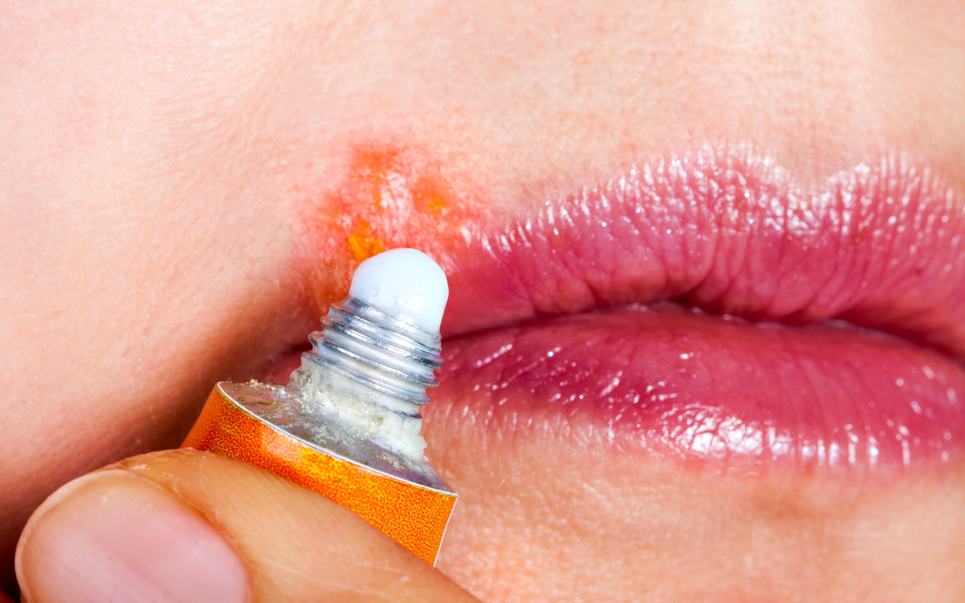 what-is-cold-sore