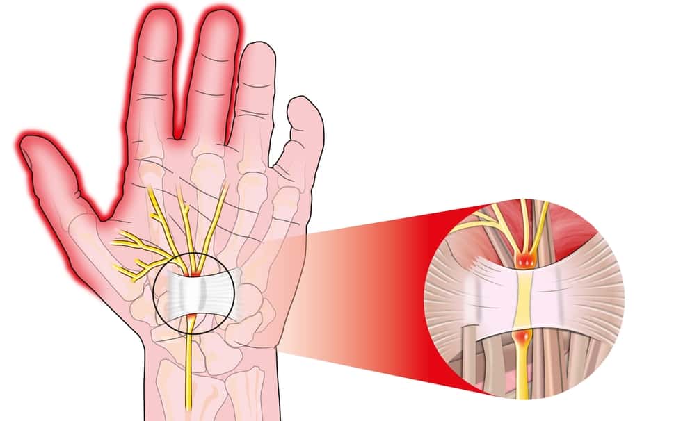 carpal-tunnel-surgery