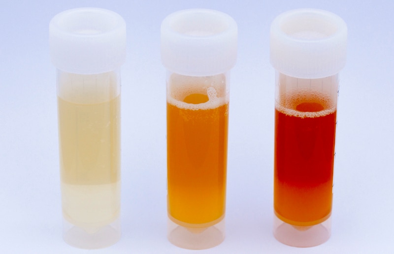 health-concerns-related-to-urine-color