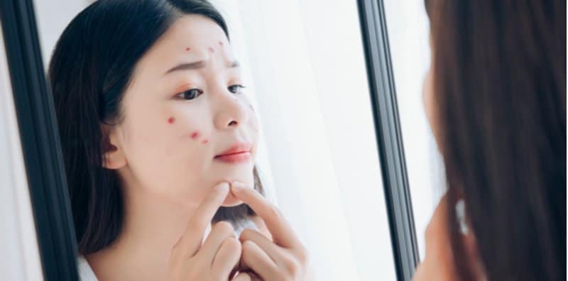 acne-preventive-skin-care