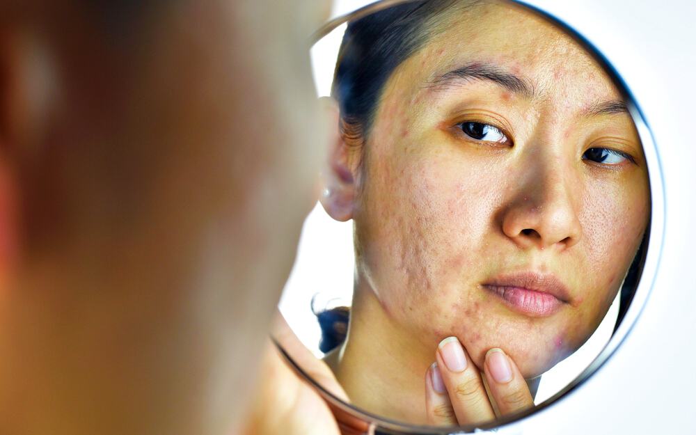 2-main-types-of-acne-scar