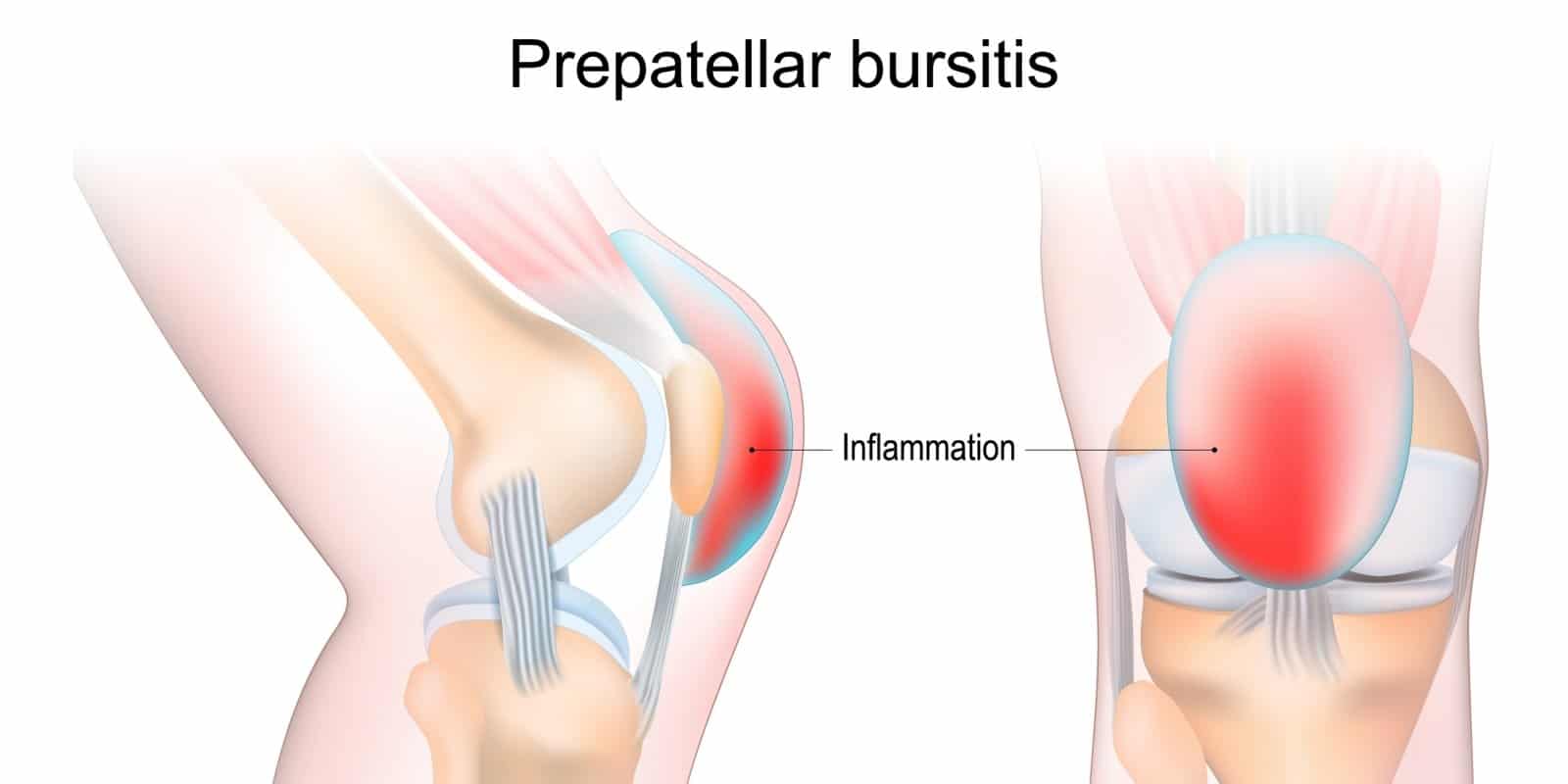 housemaids-knee-causes-and-treatment