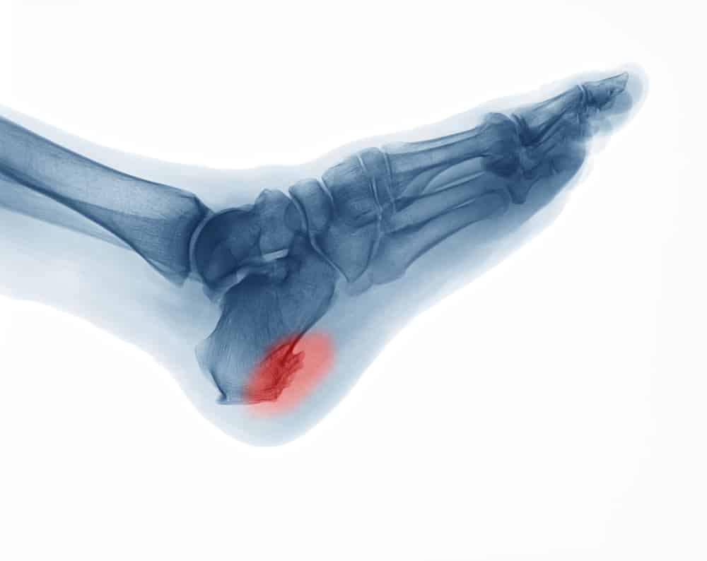 no-surgery-for-heel-spurs