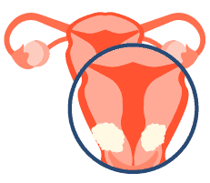 子宮頸癌