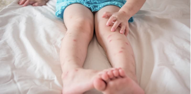 what-is-anaphylactoid-purpura
