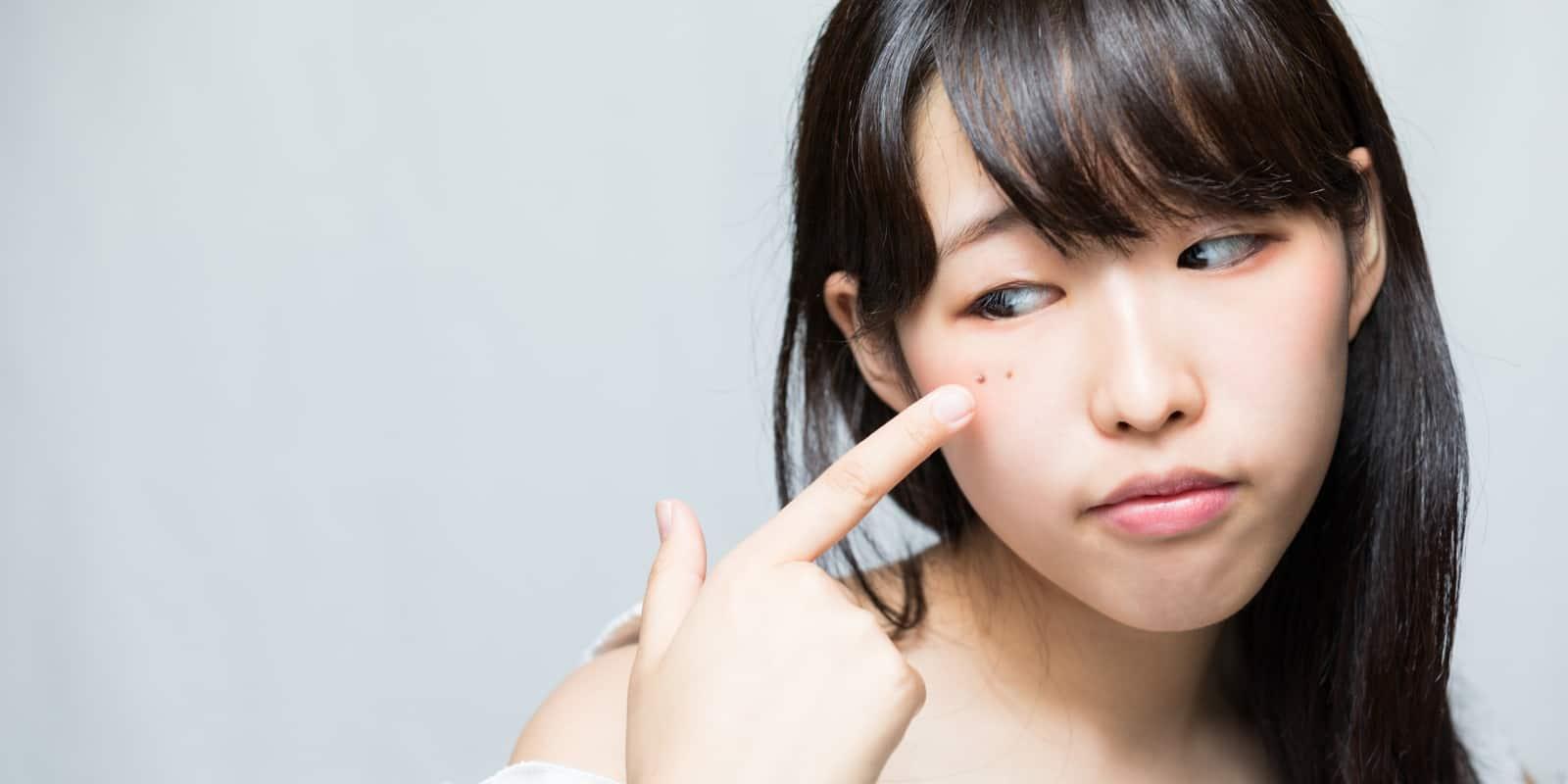 dermatosis-papulosa-nigra